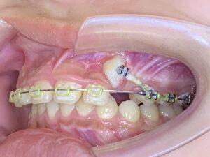 埋伏歯の牽引の写真